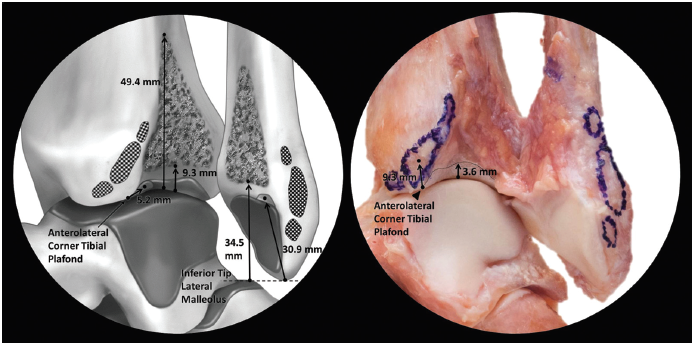 Picture 6. Open-book view of interosseous tibiofibular ligament (Williams 2015, pg 95).