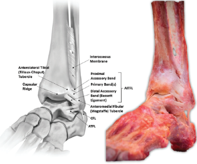 Ankle syndesmosis ligaments