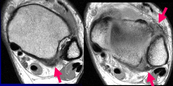 MRI of ankle syndesmosis injury. Arrows show AITFL and PITFL injury damage