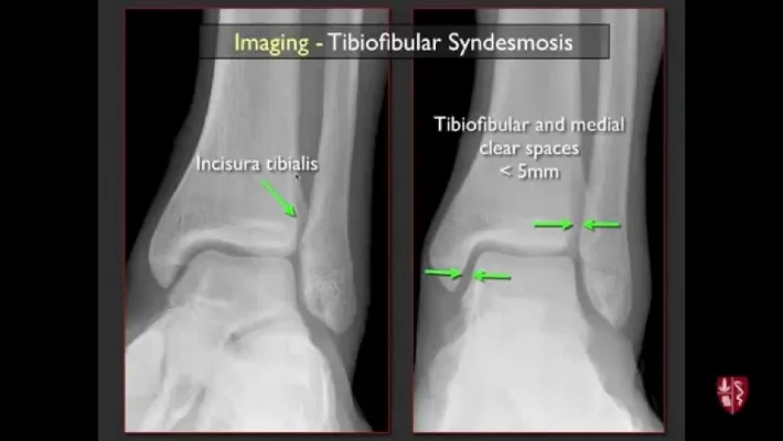 tib fib imaging.jpg