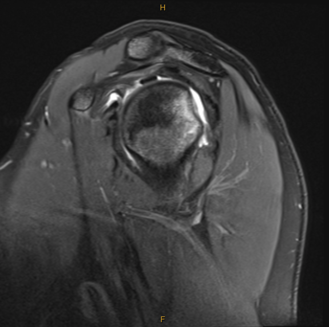 PD FS SAG Hill-sachs lesion