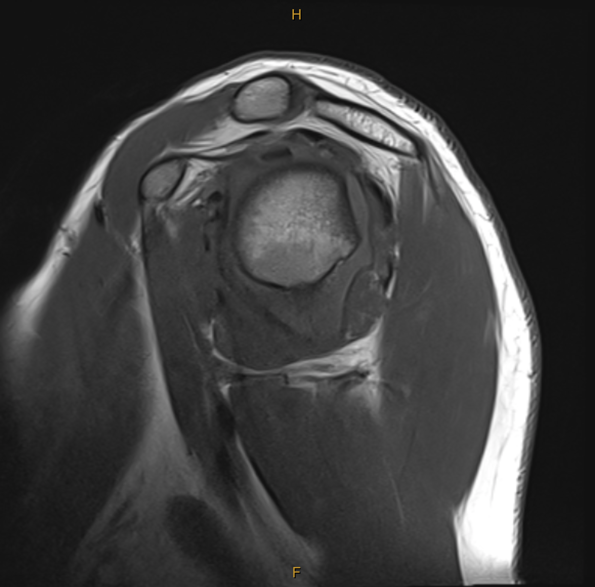 T1 SAG Hill-sachs lesion and bone marrow oedema