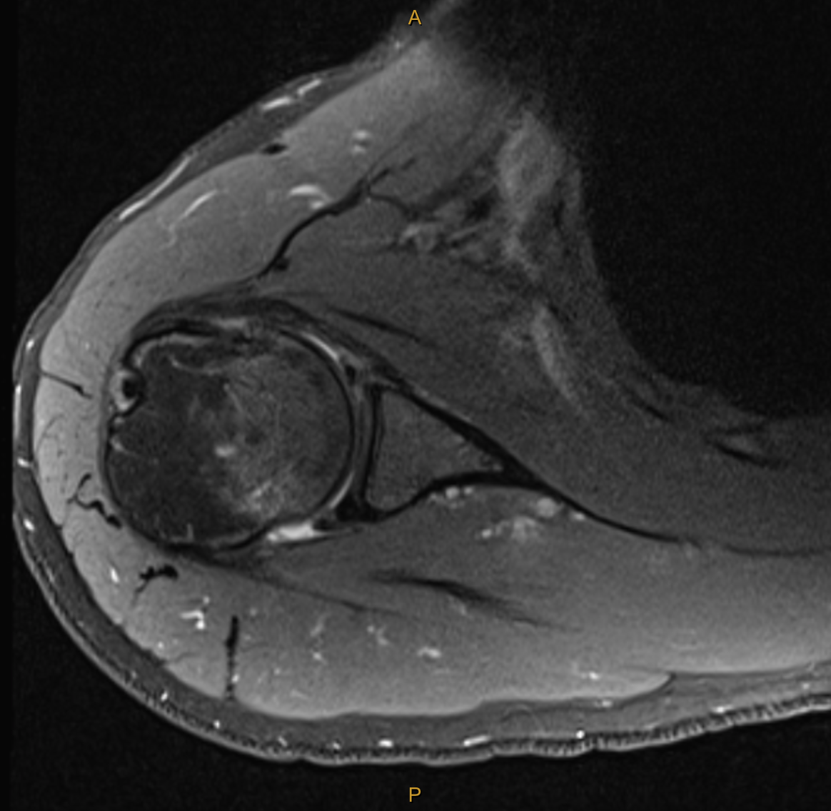 PD FS Axial periosteal stripping