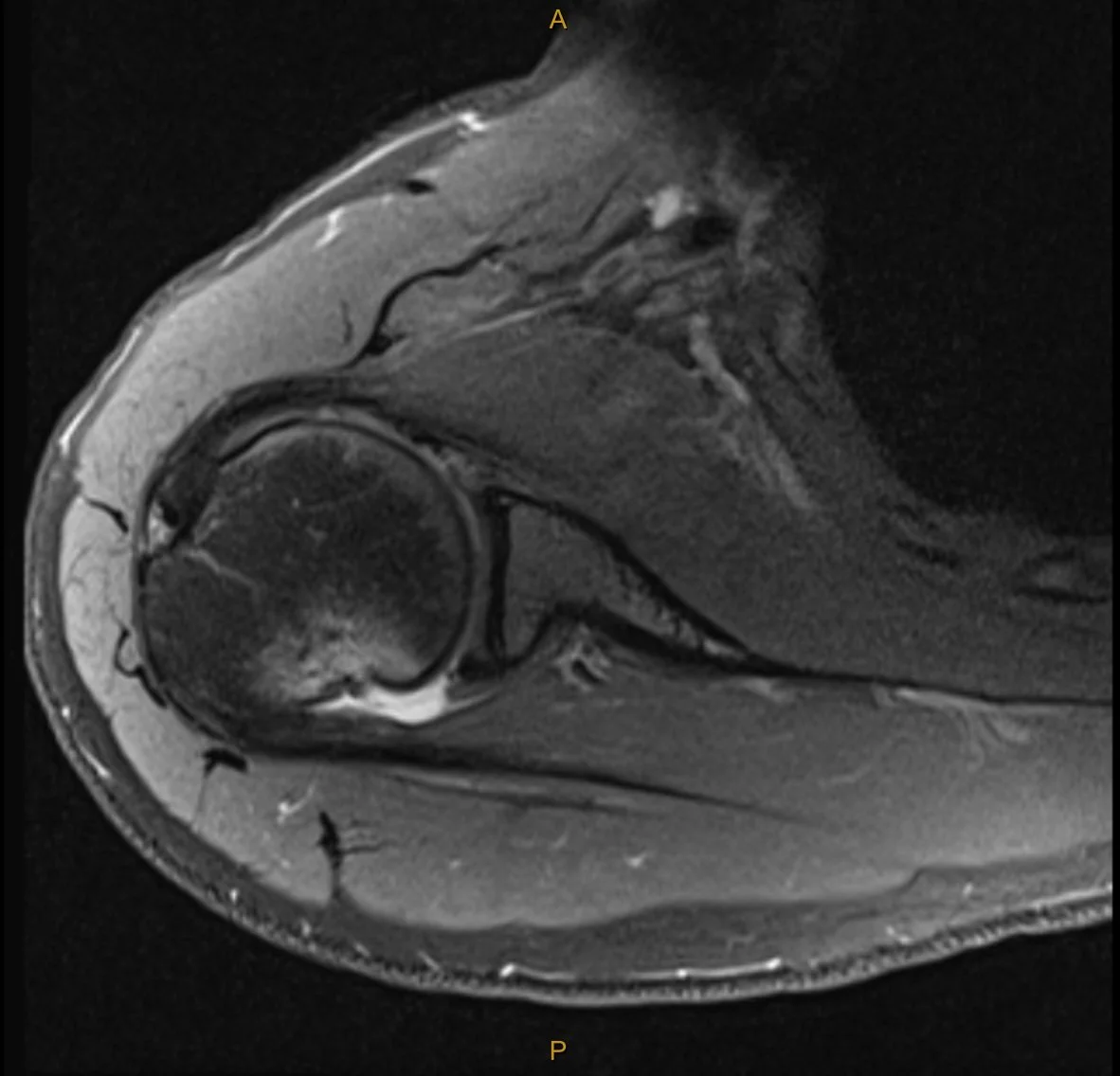 PD FS Axial Hill-sachs lesion and inferior labral tear