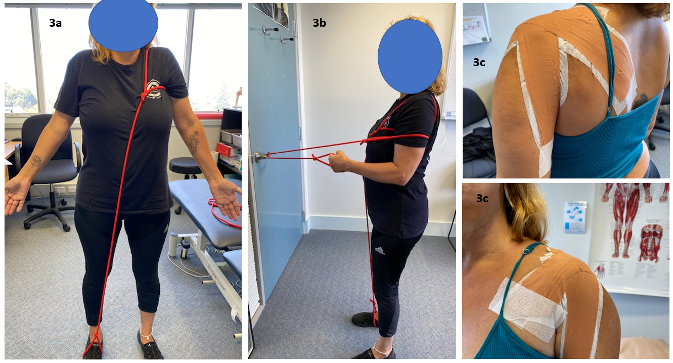 A Complex Case of Shoulder Multidirectional Instability in A Patient with hypermobile Ehlers