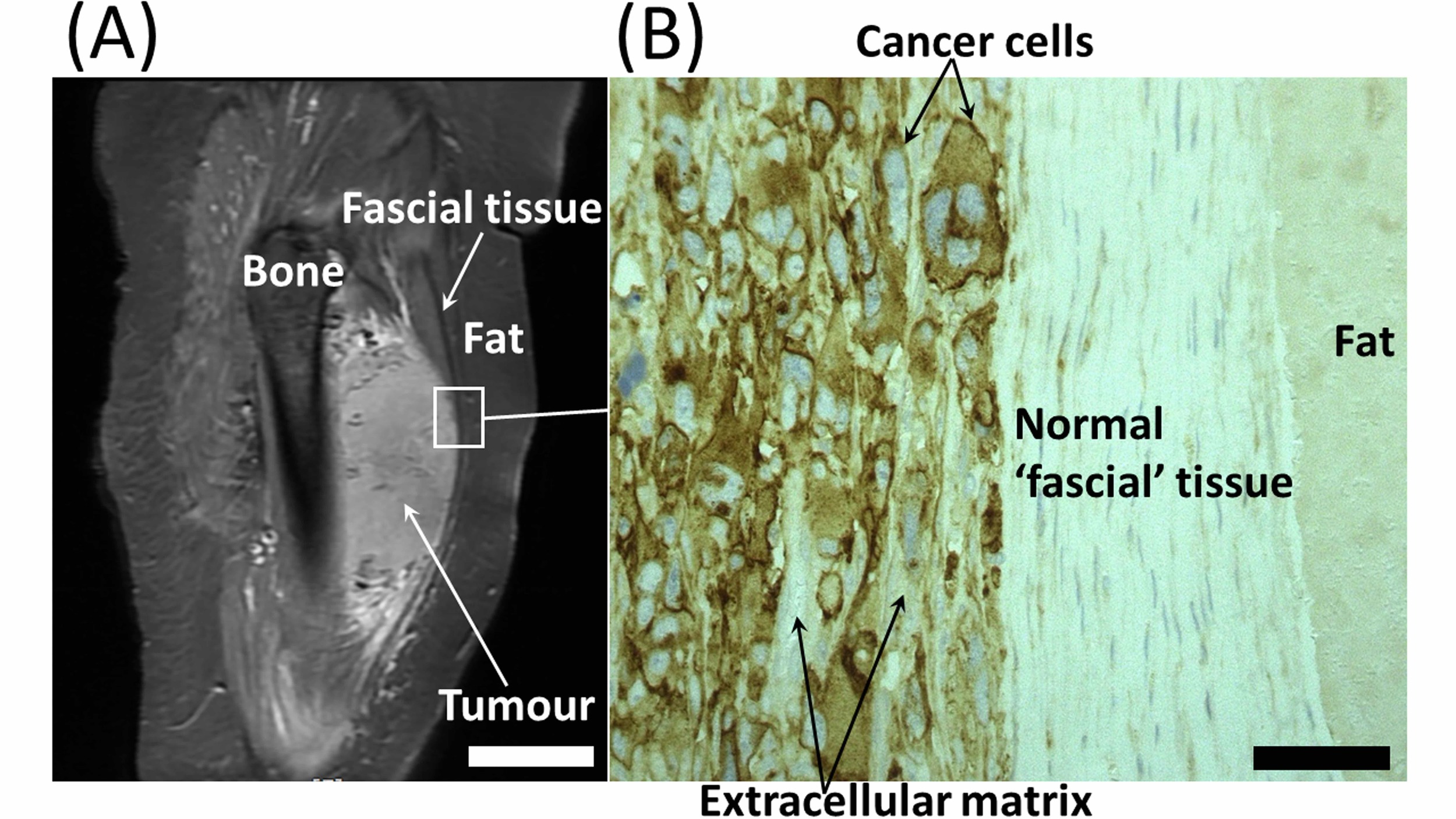Fig. 4 (A) Magnetic resonance image of a soft tissue tumour in the thigh.The lighter grey appearance of the tumour is due to the high cellular content and different ECM components of the tumour compared to the bone, normal fascial tissue and fat. Scale bar = 20 mm. (B) Histological section of the interface between the tumour and normal tissues. The intense brown staining in the cancer cells is due to high expression of the invasive enzyme membrane type-1 matrix metalloproteinase. This enzyme cleaves the hyaluronan receptor CD44. Scale bar = 50 microns.