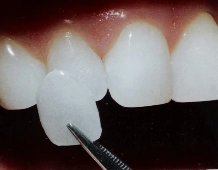 veneer.jpg