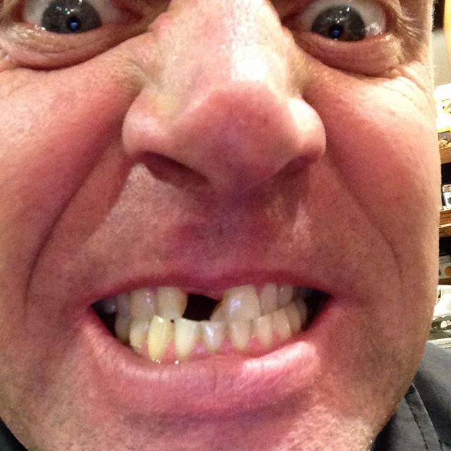 I ran into a wall three years ago and lost my tooth and the dentist glued it back in bit into a grab sandwich today tooth is gone man I want to chrome front tooth who got a hook up #dontstandinfrontofmewhenitalkyoullgetspiton