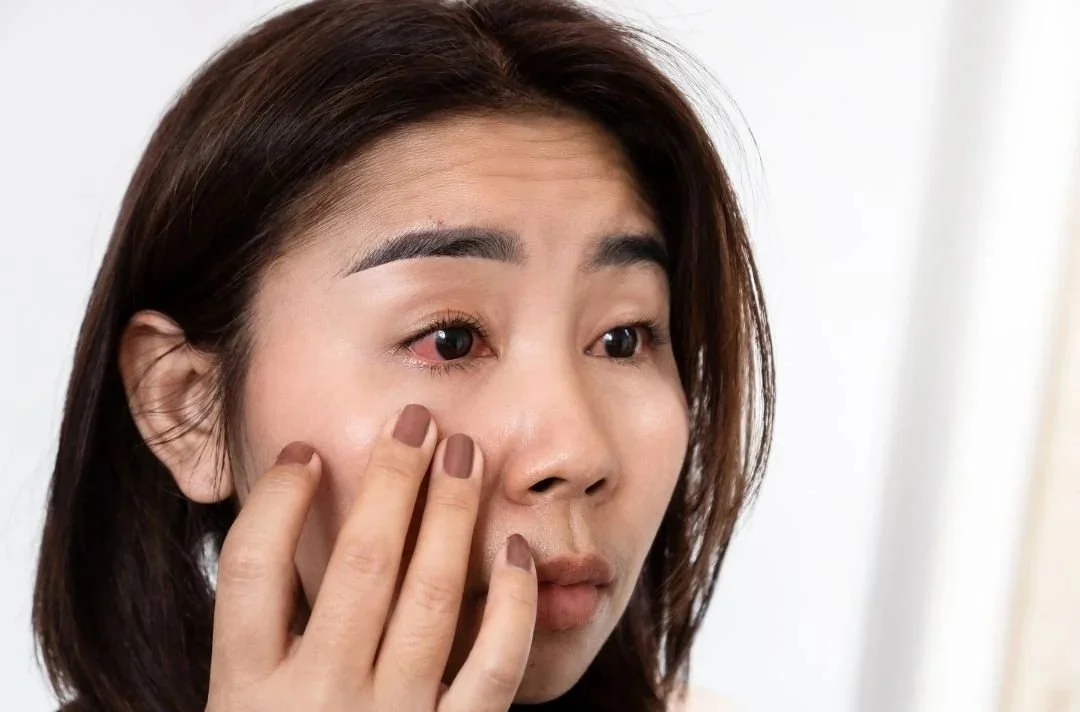 Pink Eye