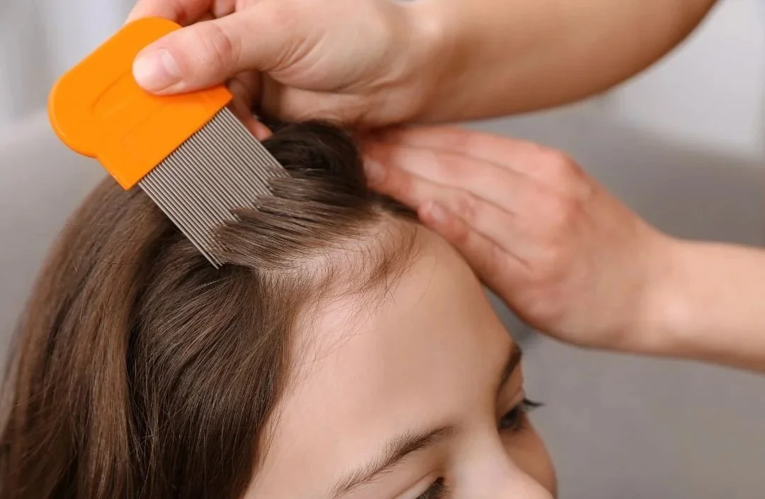 NEW 2026 - Head Lice
