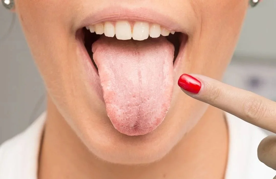 Oral Thrush