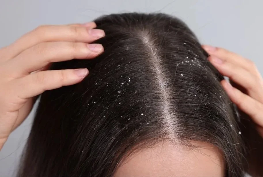NEW 2026 - Dandruff
