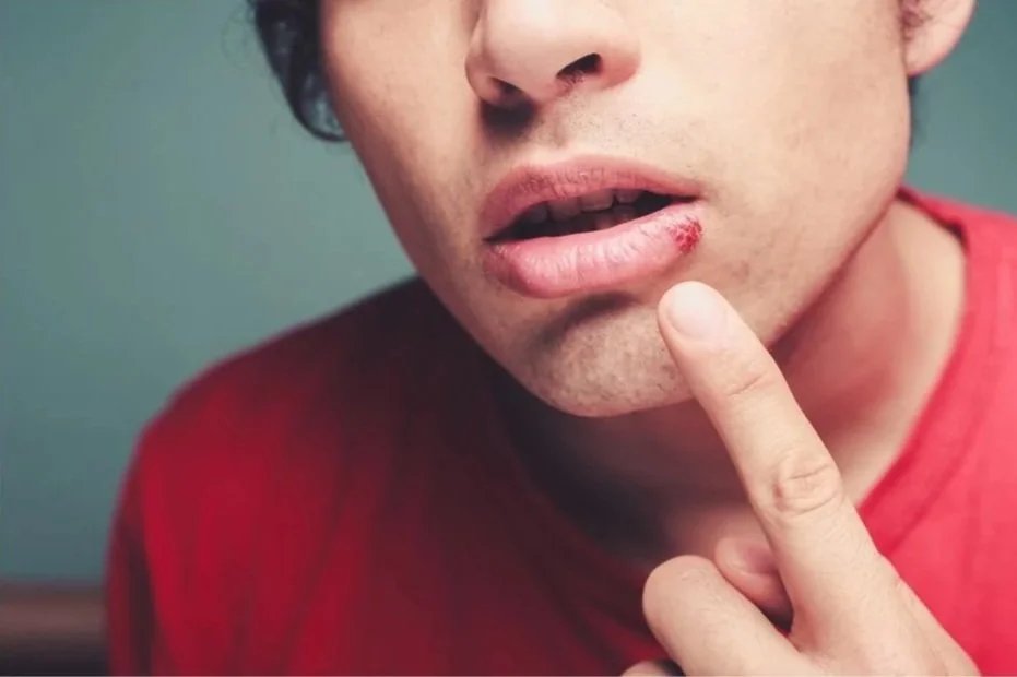Cold Sores