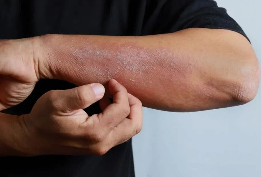 Eczema