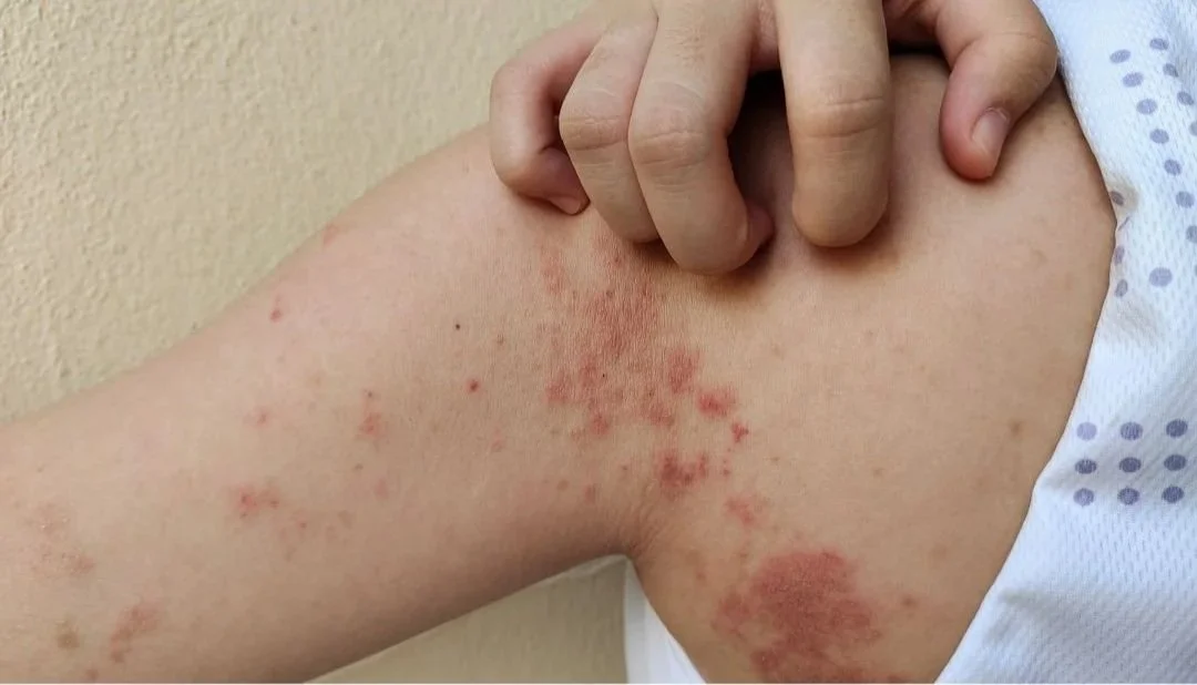 Impetigo