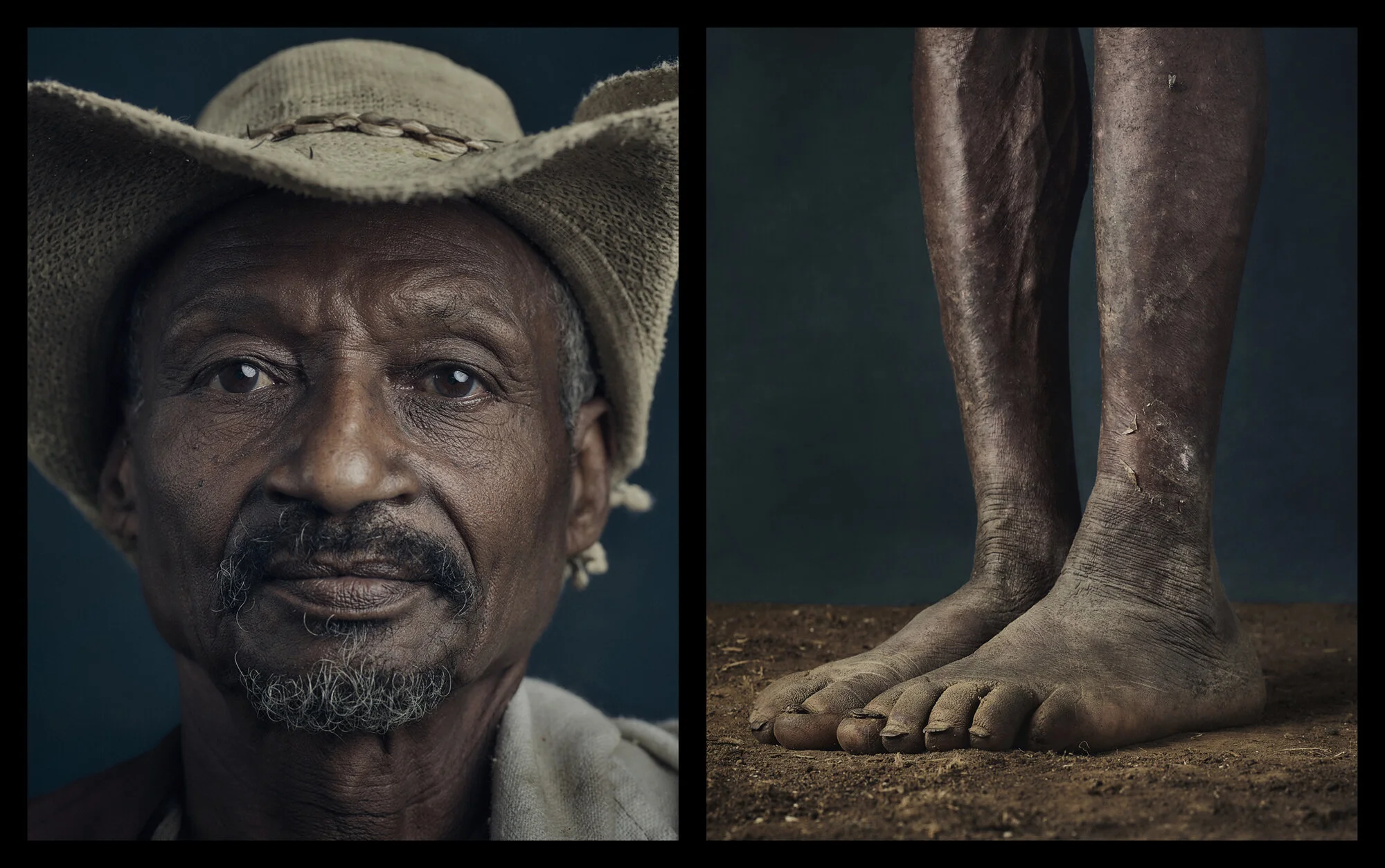 podoconiosis ethiopia portrait