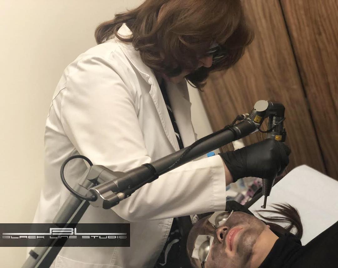 Carbon peel laser treatment