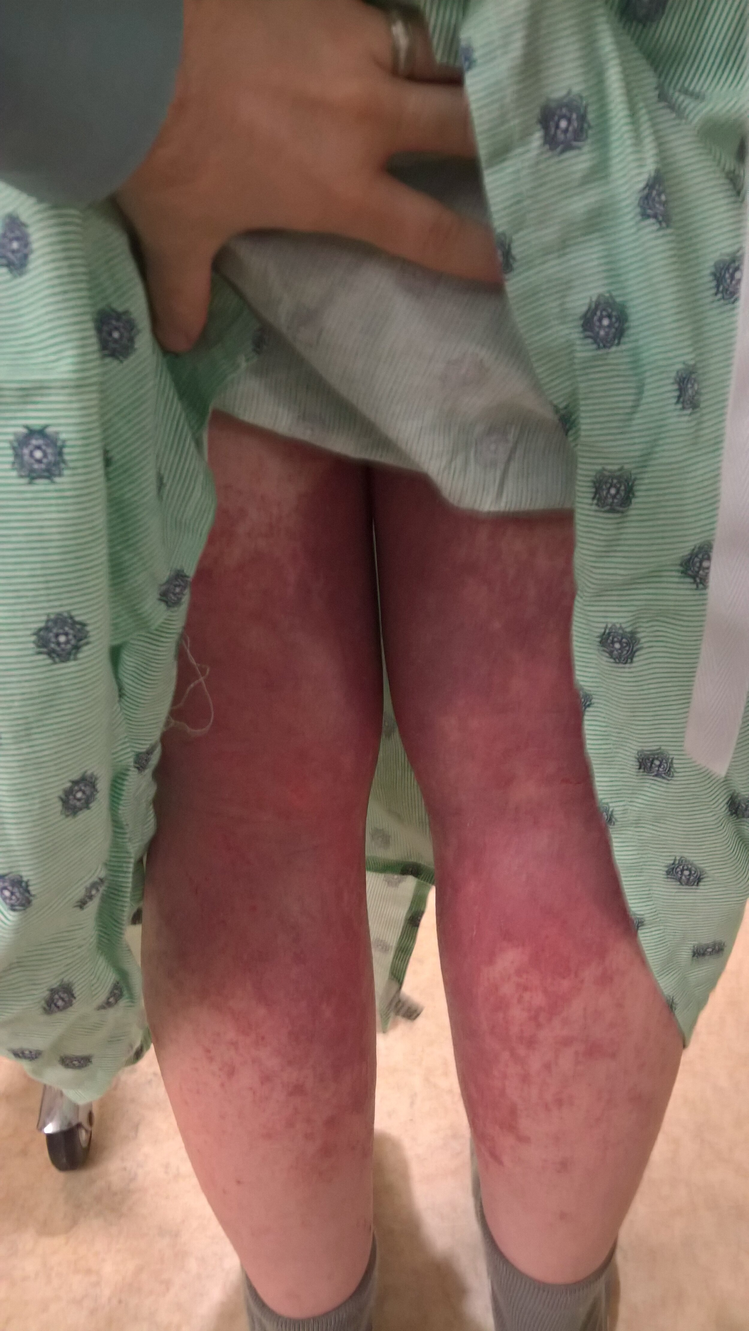 Jessica Morrison - Back of Legs without Flash Emergency Room - Topical Steroid Withdrawal.jpg