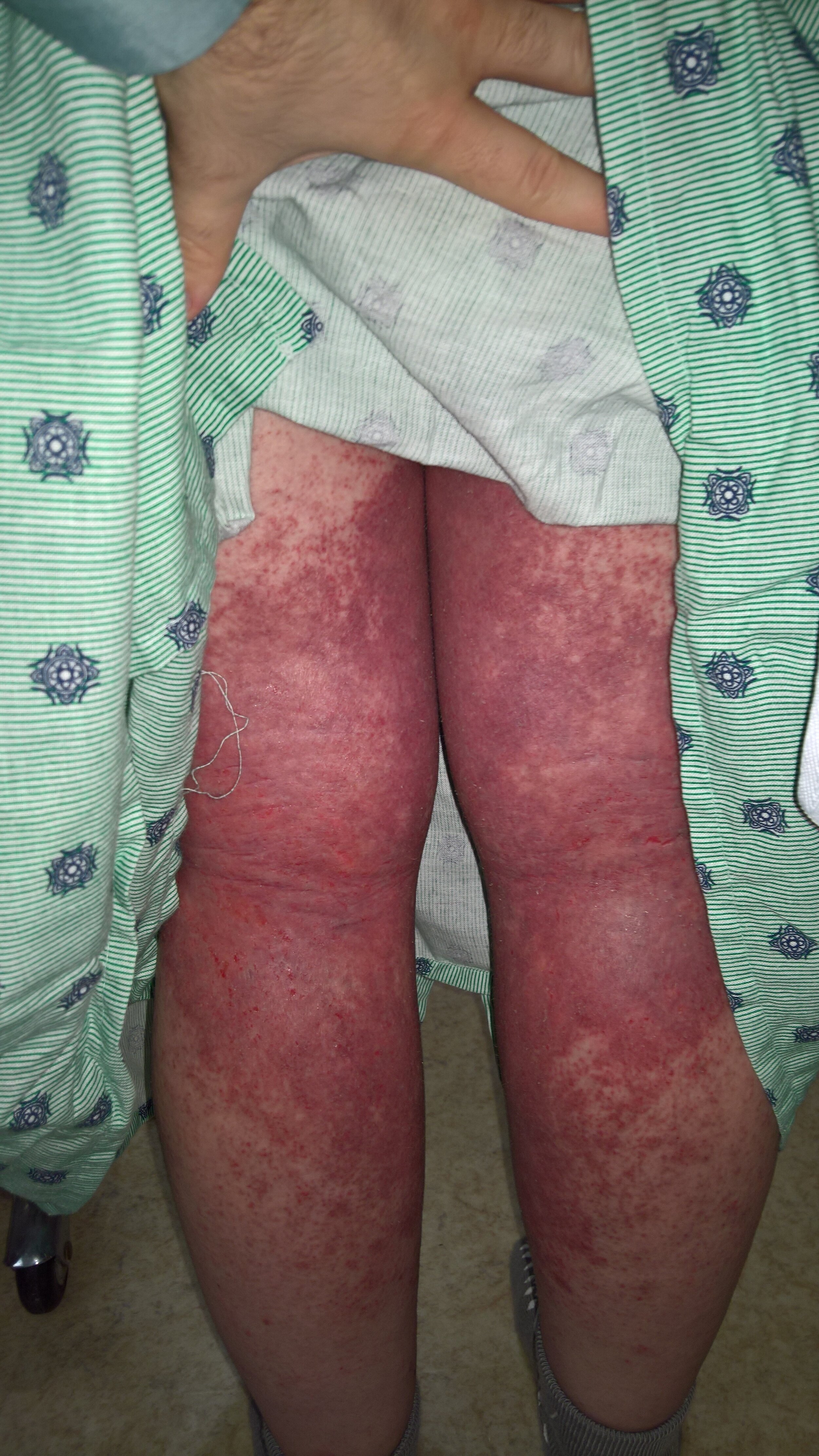 Jessica Morrison - Back of Legs with Flash Emergency Room - Topical Steroid Withdrawal.jpg