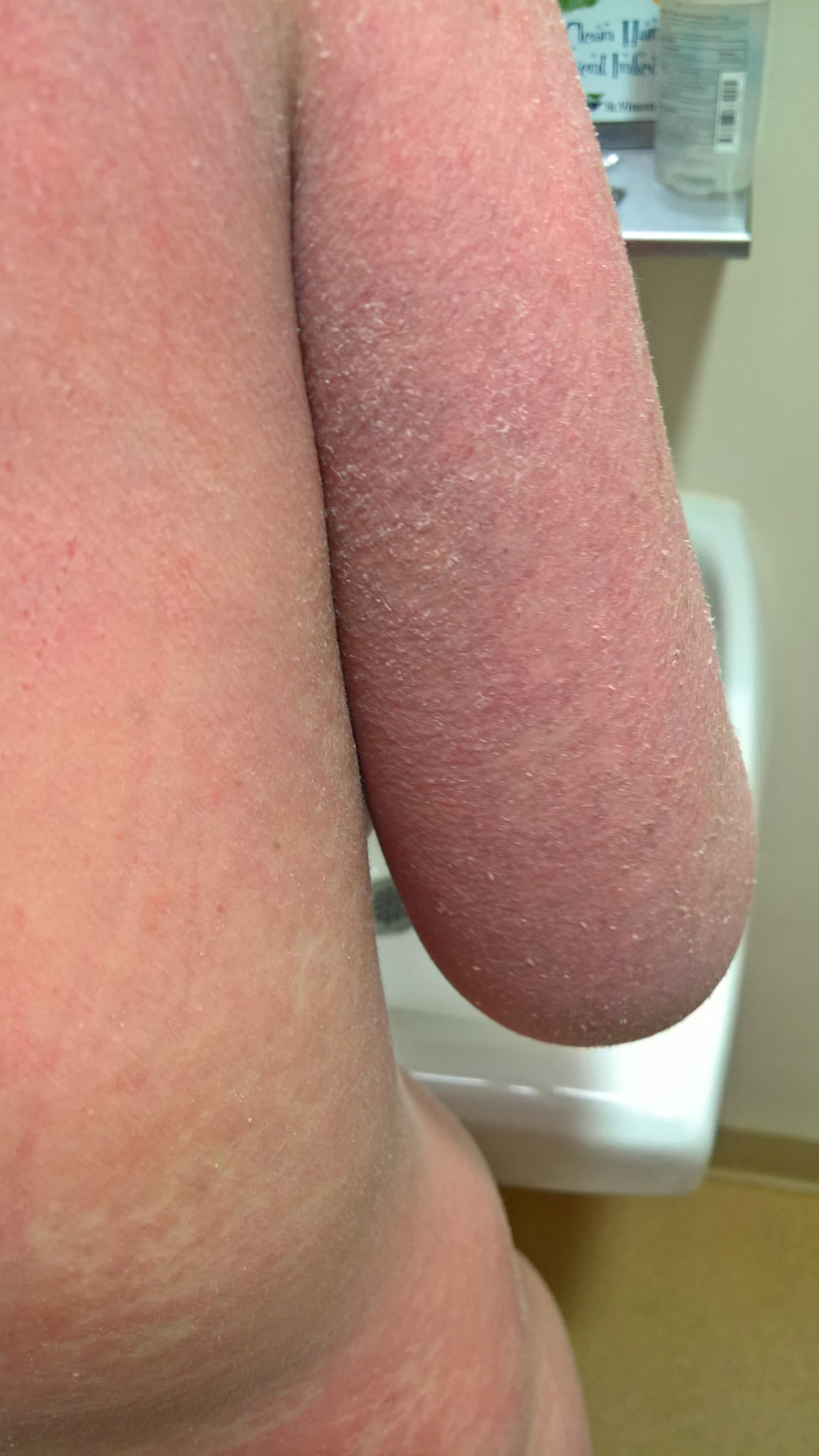 Jessica Morrison - Back of Right Arm and Side Emergency Room - Topical Steroid Withdrawal.jpg