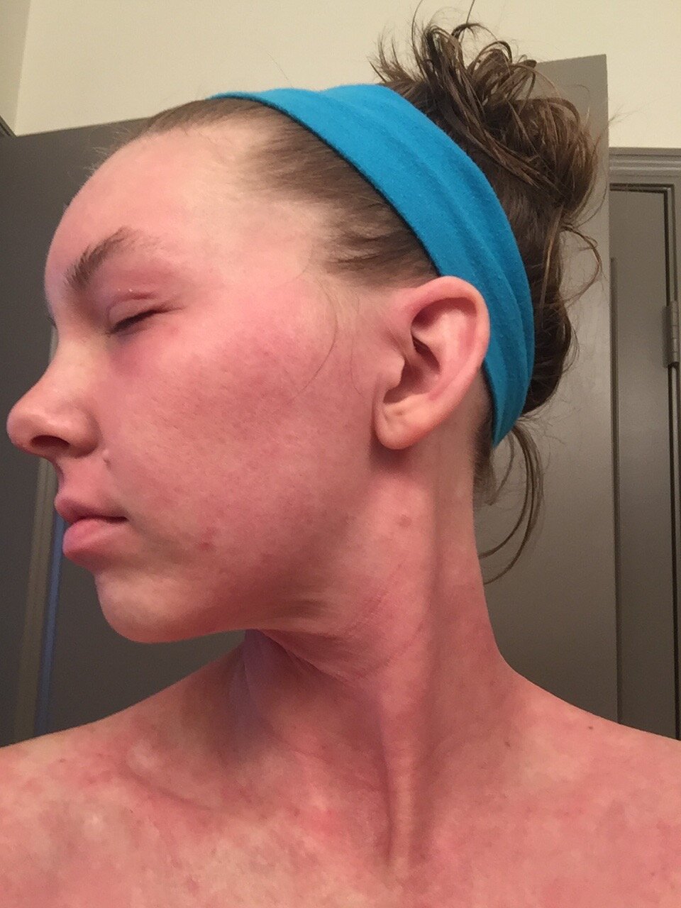 Jessica Morrison - Early Signs of Addiction Left Face September 2015 - Topical Steroid Withdrawal.jpg