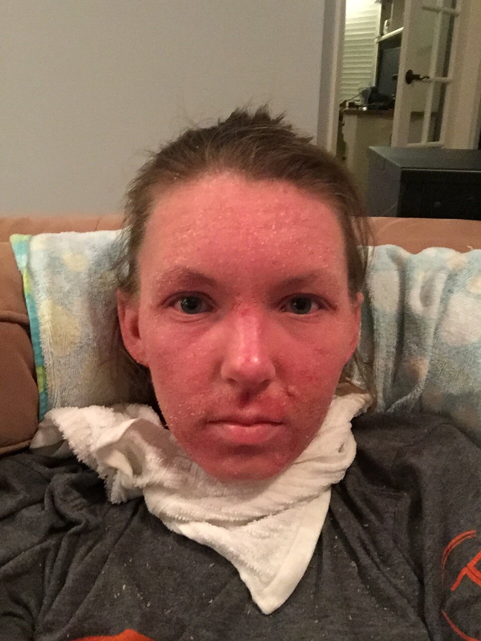 Jessica Morrison - After the Hospital Face December 2016 - Topical Steroid Withdrawal.jpg