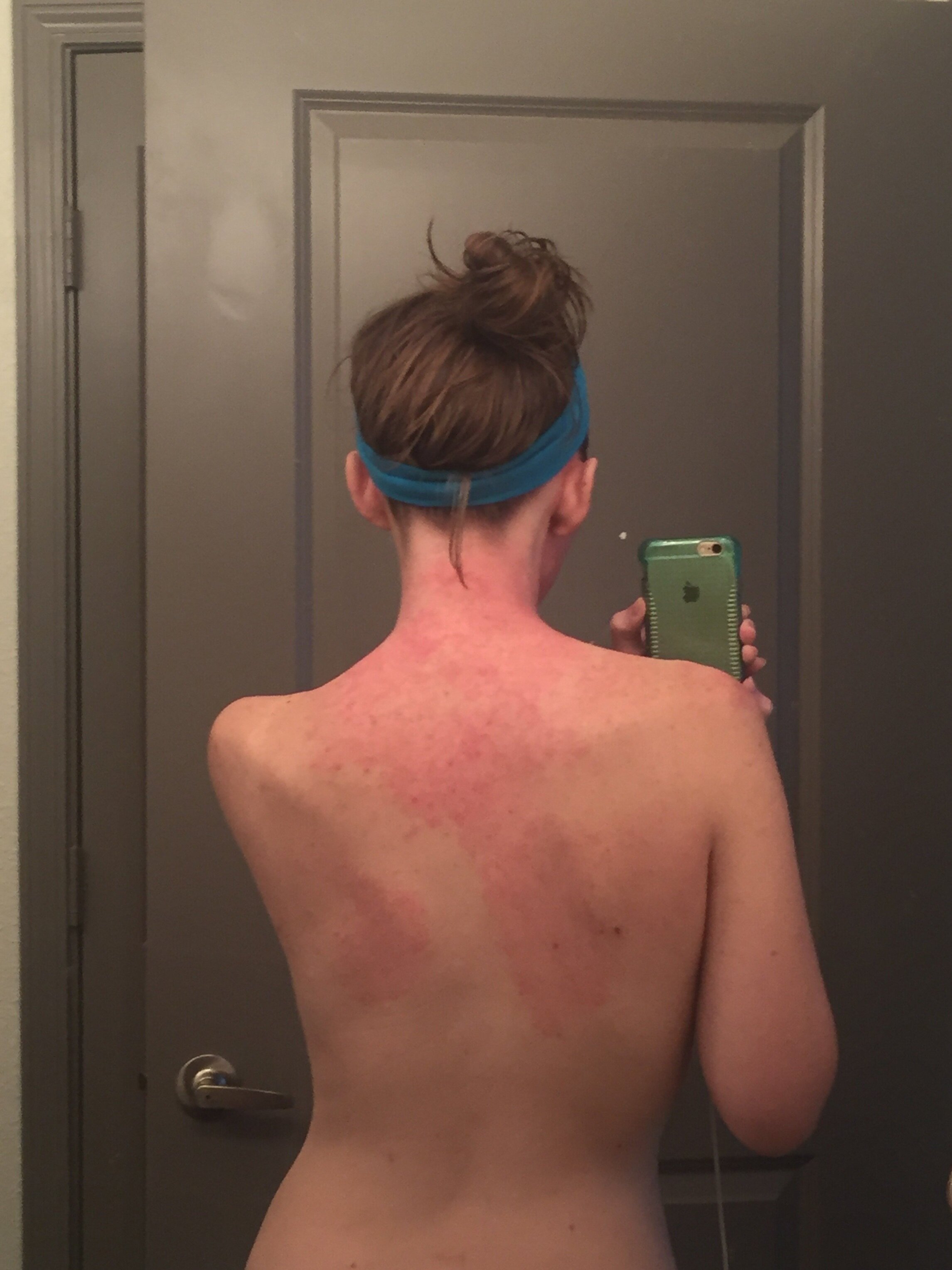 Jessica+Morrison+-+Early+Signs+of+Addiction+September+2015+-+Topical+Steroid+Withdrawal.jpg