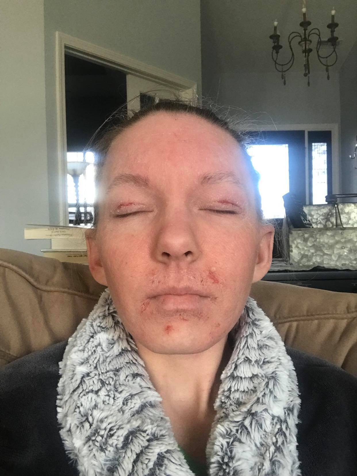 Jessica Morrison Summer 2019 Topical Steroid Withdrawal Face Front 2.jpg