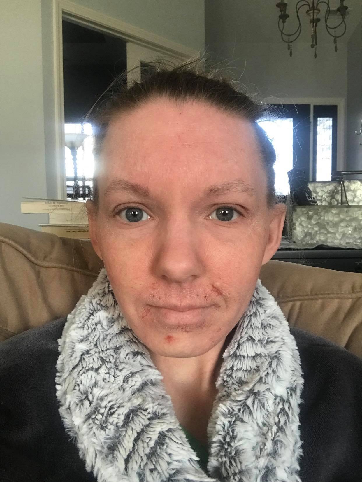 Jessica Morrison Summer 2019 Topical Steroid Withdrawal Face Front.jpg