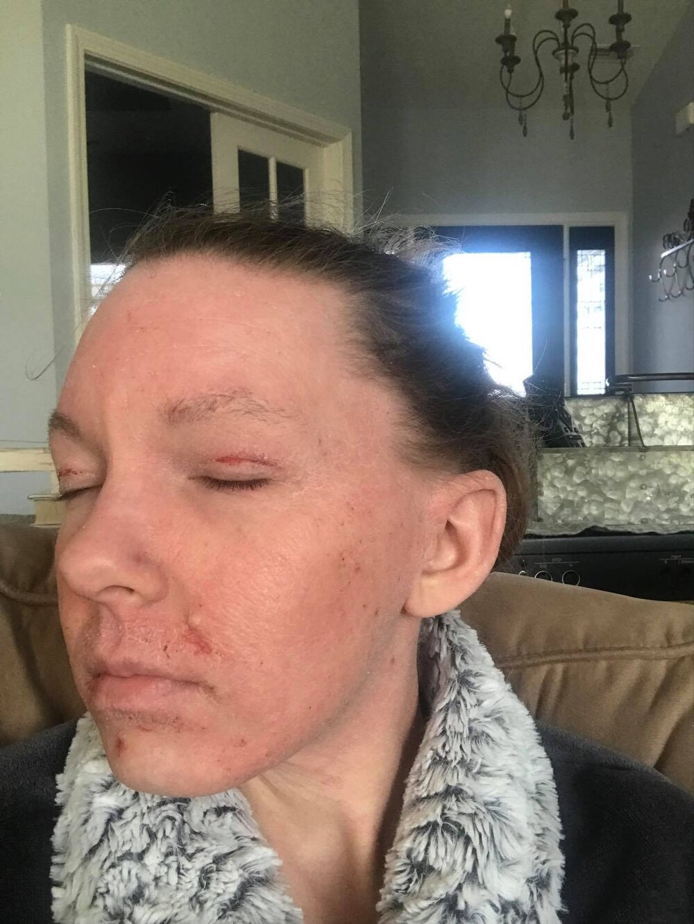 Jessica Morrison Summer 2019 Topical Steroid Withdrawal Left Face.jpg