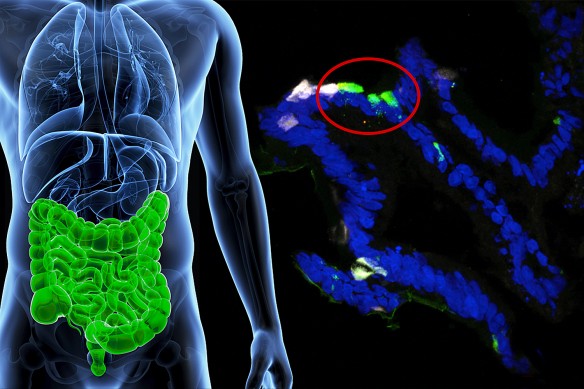 Human gastrointestinal cells from patients were engineered to express insulin (fluorescent green) in the lab. (Image by Columbia University Medical Center.)