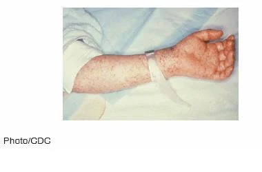 Rocky Mountain Spotted Fever Rash