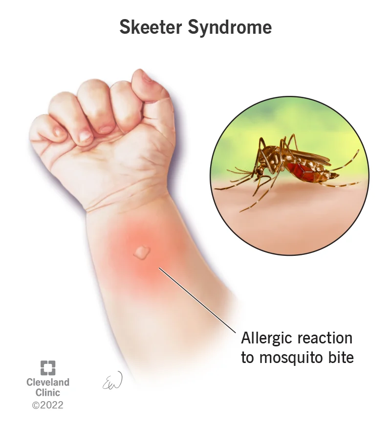 Mosquito Bite Diagram Mosquito Bite Diagram