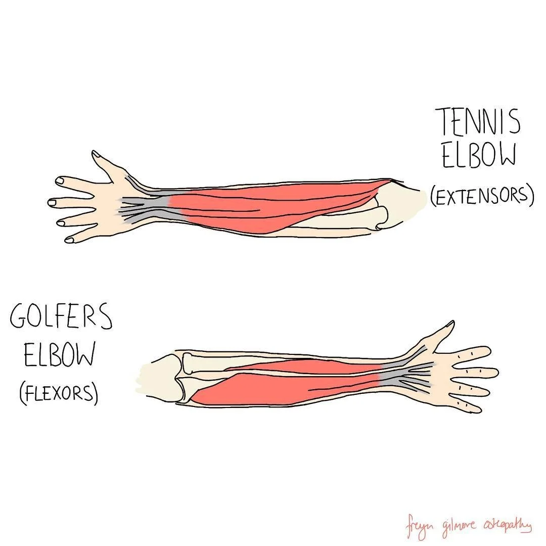 Tennis Elbow