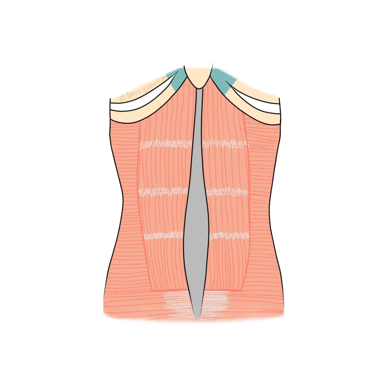 Diastasis Recti