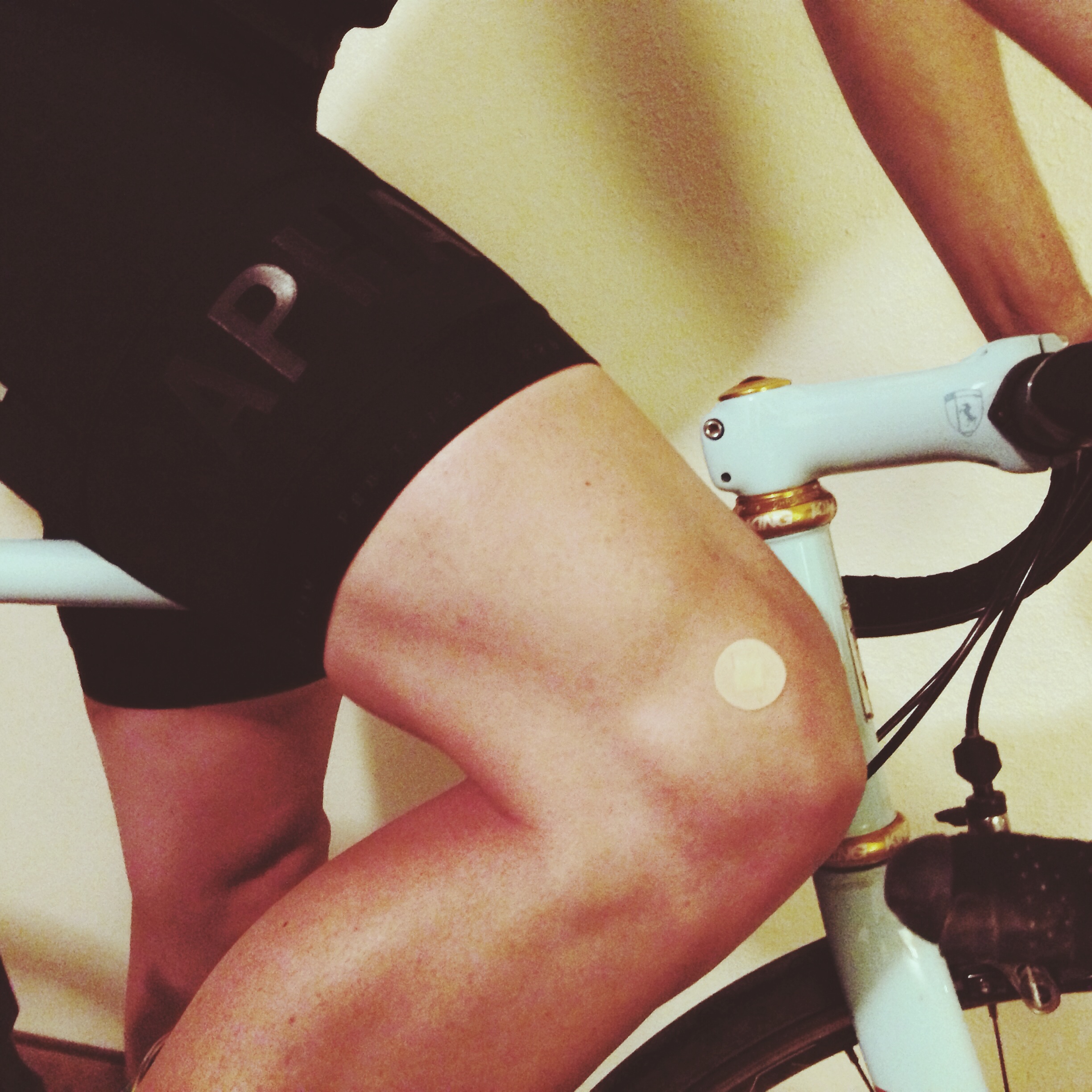 Andrew was in pain so he got a Cortisol shot on day 5 of the ride. But that tiny bandaid actually hid a really big problem. A genetically misaligned kneecap which resulted in torn ligament & cartilage on the back of the patella. The cartilage can't be repaired.