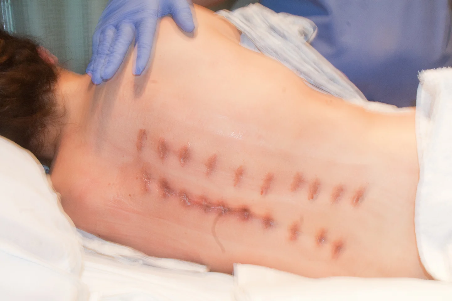 13 hour surgery. 2 rods. 20 screws. 1 incredible surgeon, Dr. Jeffery Roh. He treats his patients like family. This is a newer, minimally invasive procedure instead of one long incision. It was exciting to be a part of cutting edge medicine. I've ne…