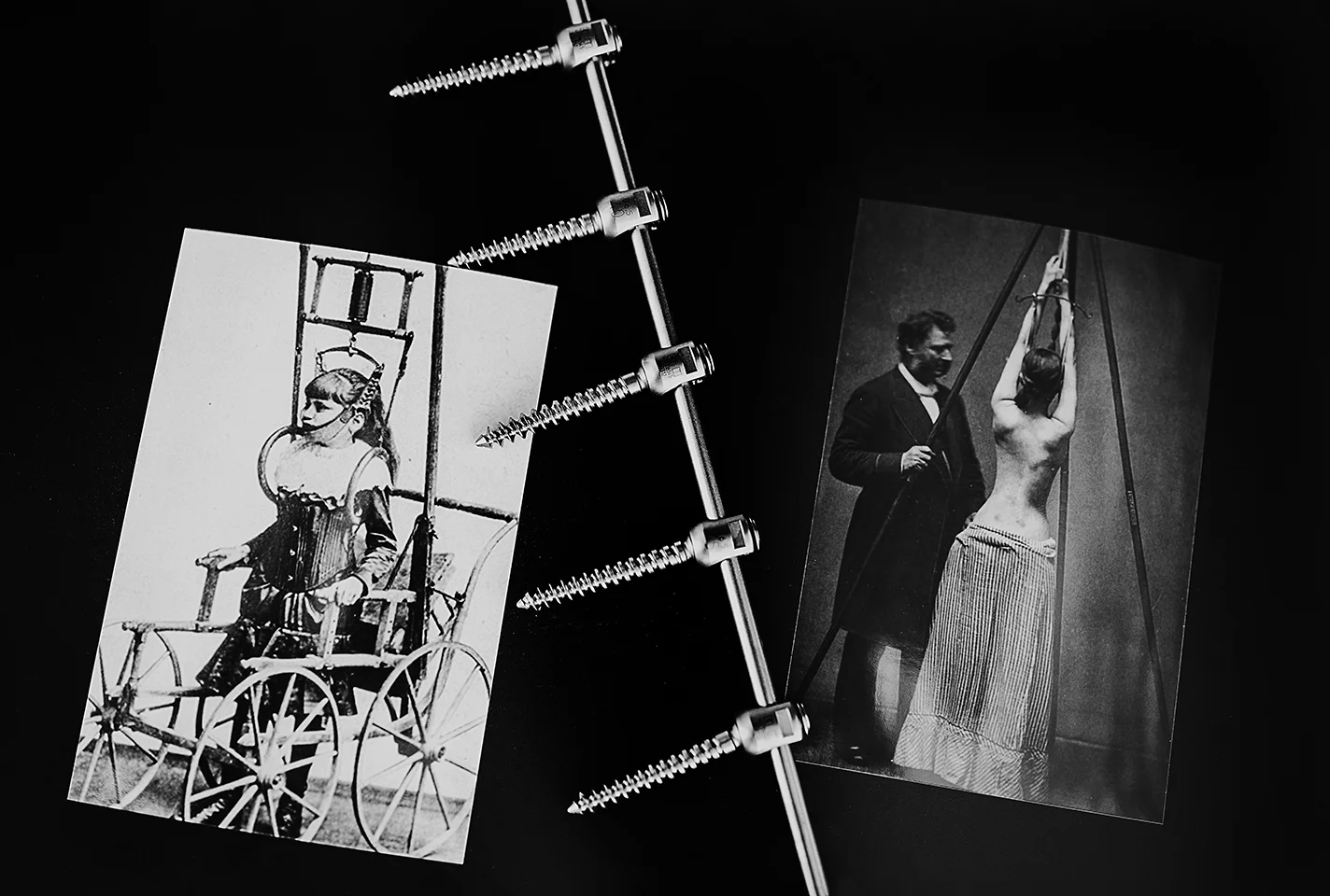 I've never been more grateful to be alive in the 21st century. I don't have to wheel around a handcart of a back brace or be suspended from a rod for lengthy periods of time. 50 years ago after spine surgery, patients had to lay flat on their backs …