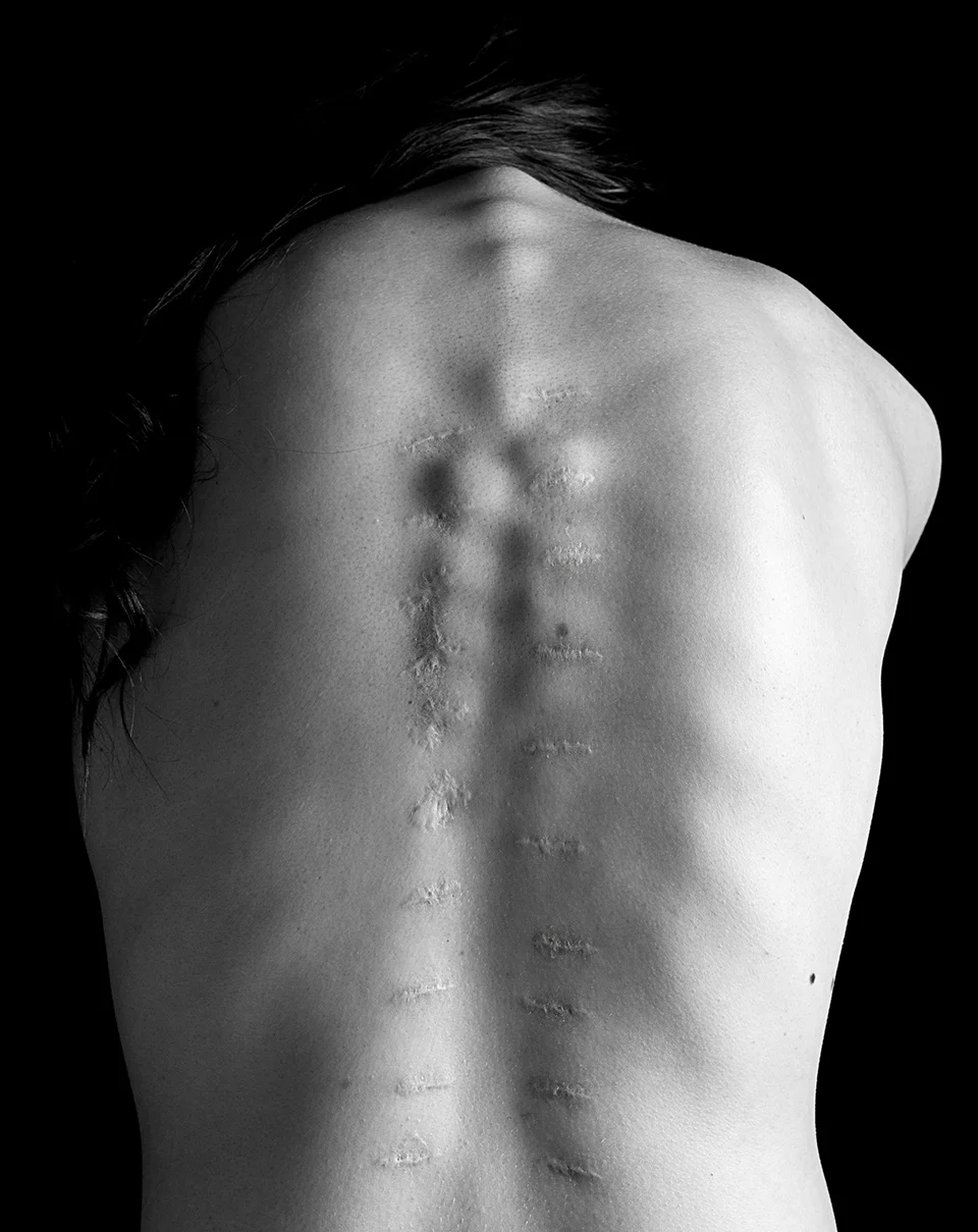 I love my scars. I find them interesting and beautiful. Oh, and they make me feel tough. A majority of people don't know I've had this surgery. So, we never know what is going on under the surface. A church leader I love, Henry B. Eyring said, "Approach everyone with the sensitivity that they are going through a challenge. More than half the time you'll be right." Don't forget to be kind.