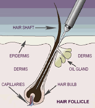 electrolysis be.png