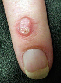 wart.jpg