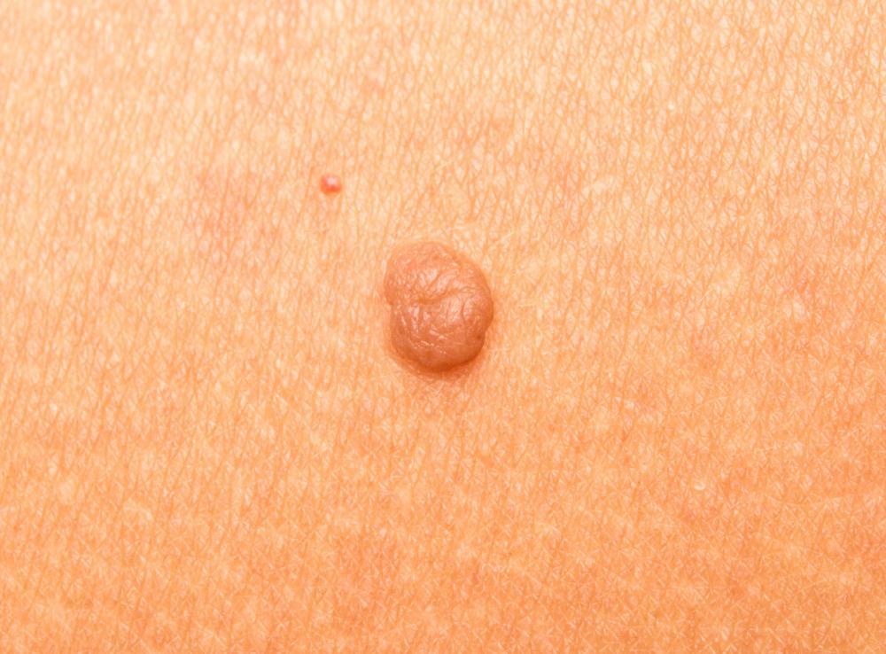 Skin-Tags-2.jpg