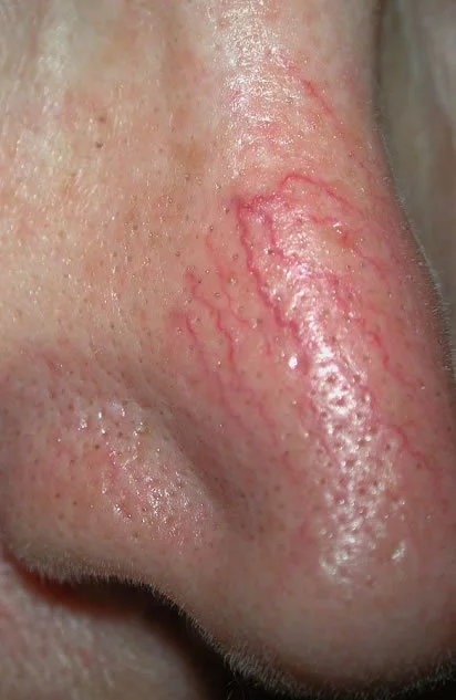 facial thread veins.jpg