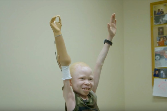 Tanzanian Albino Children Get New Limbs in U.S.