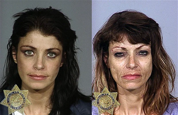 Heroin addiction - before and after. What causes people to become addicted to drugs?