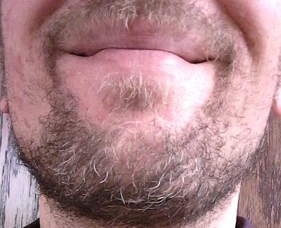 Same face, present day. Scarring covered by poorly shaven beard.