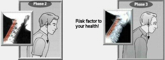 What is forward head posture?