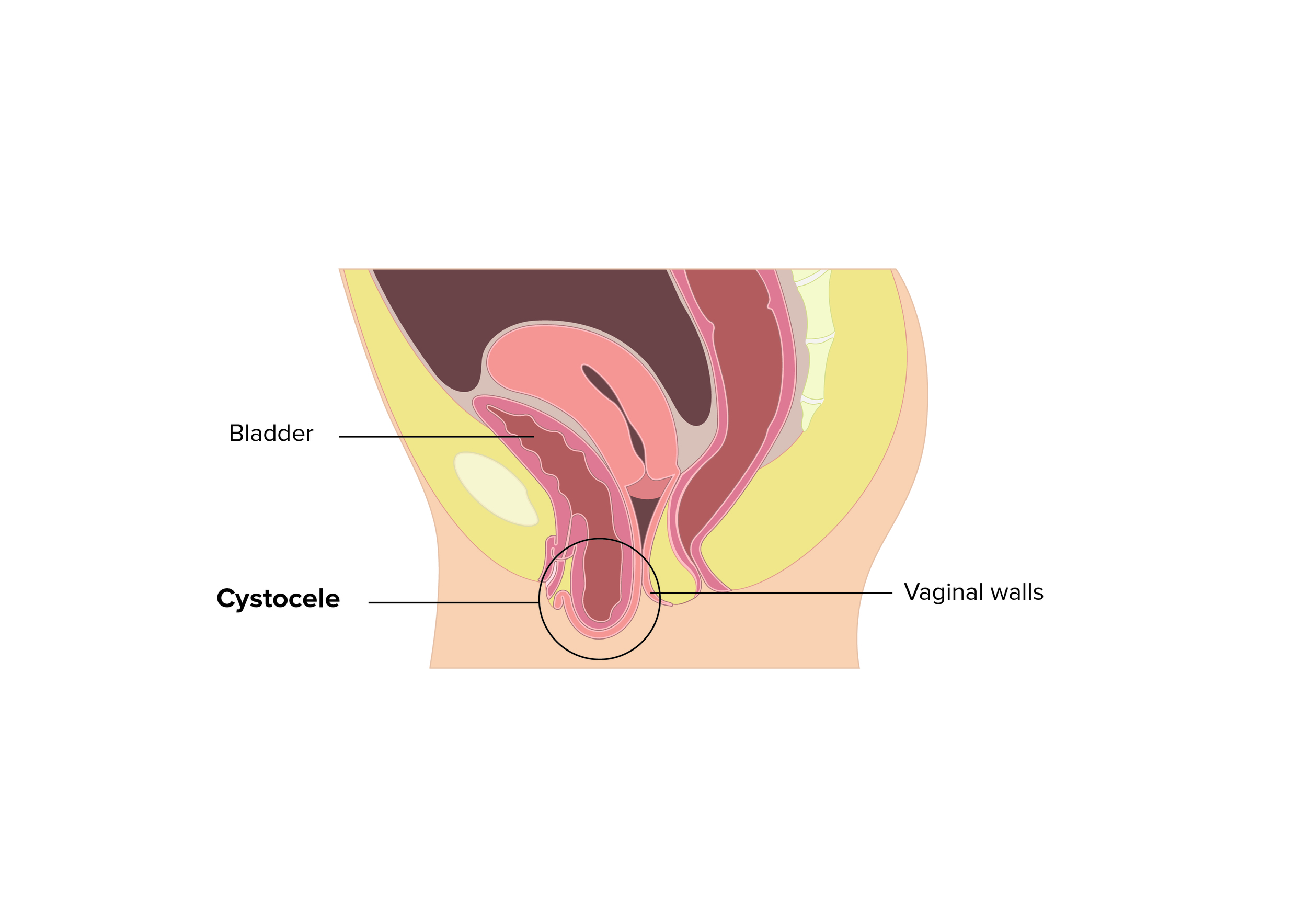 CYSTOCELE PROLAPSE