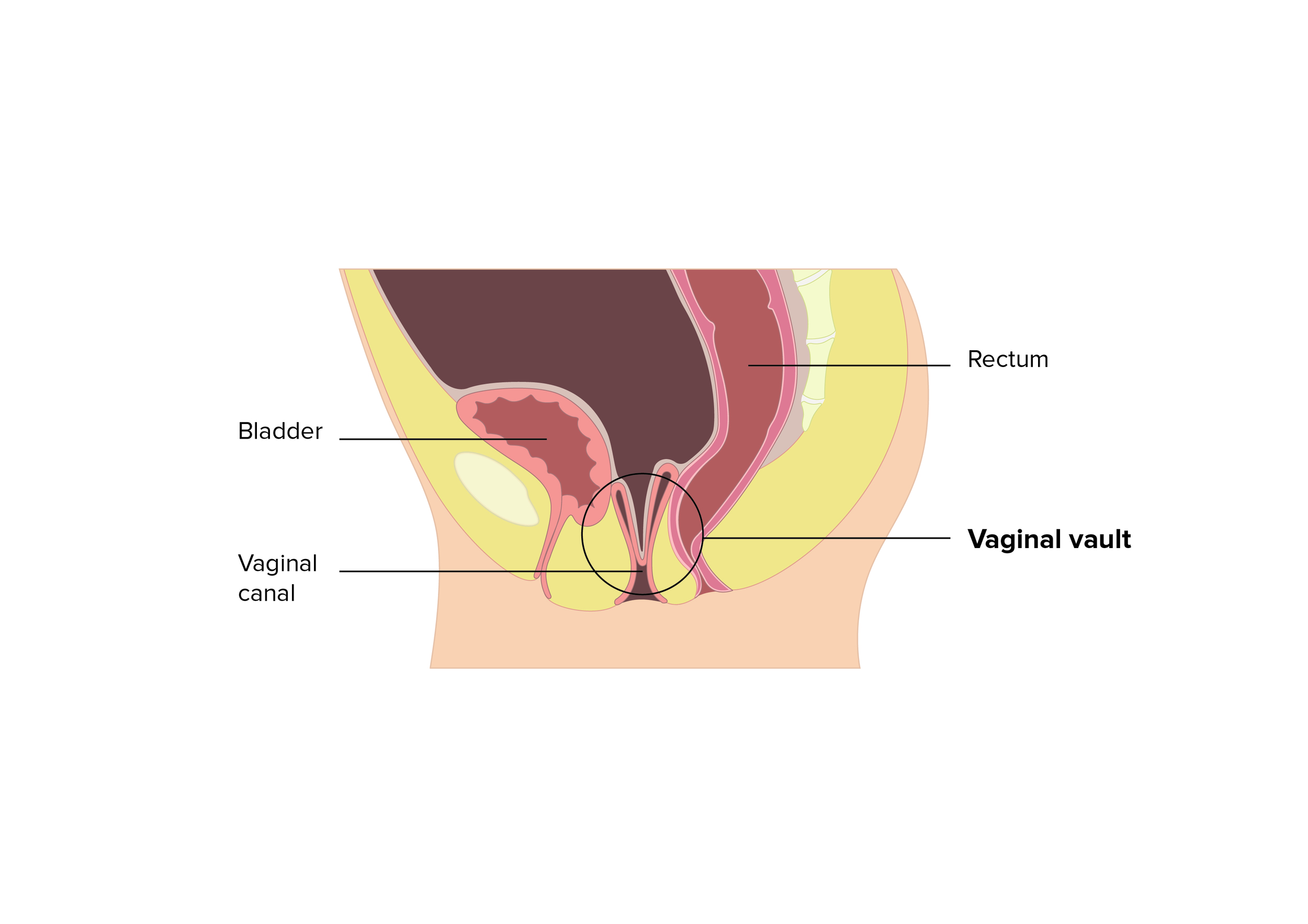 VAGINAL VAULT PROLAPSE