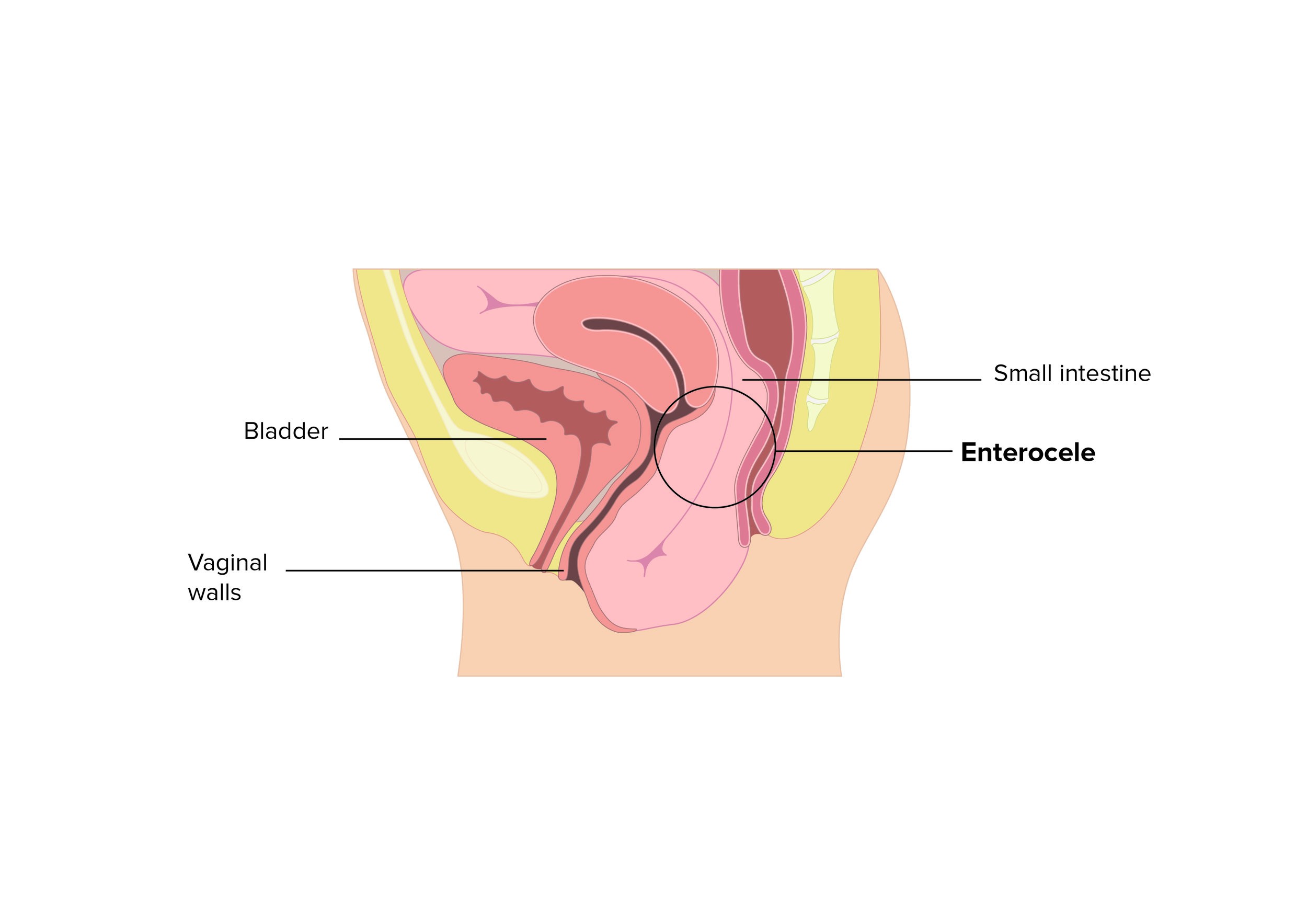 Enterocele back side of vagina. 